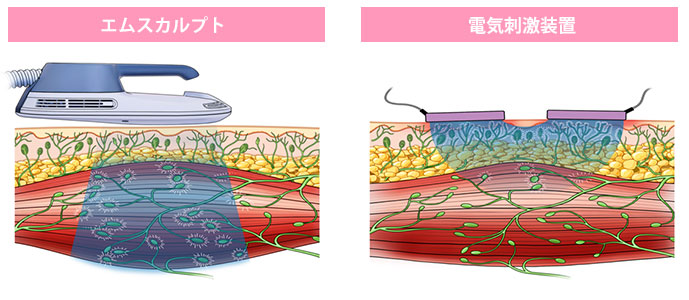 エムスカルプトと電気刺激装置の比較