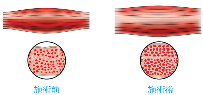 超極大筋収縮による筋肉の成長