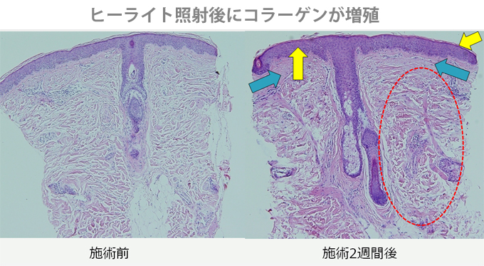 医療用新世代LEDヒーライト